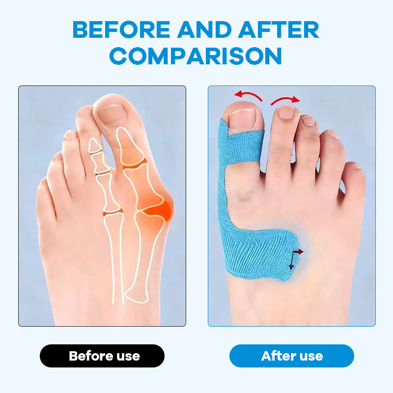 Voorgesneden kinesiologietape voor hallux valgus